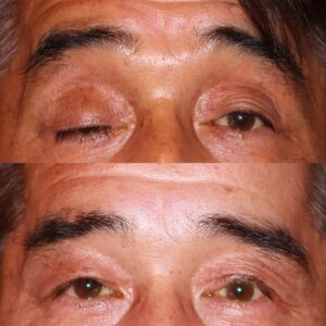 眼瞼下垂症例写真4