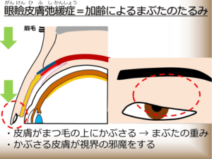 眼瞼皮膚弛緩症