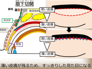 眉下切開(眉毛下皮膚切除術)