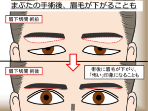 まぶたの手術後に眉毛が下がり、怖い印象になることもある