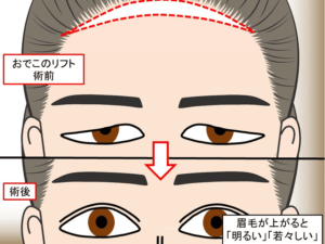 眉毛を引き上げると、若々しい印象になる