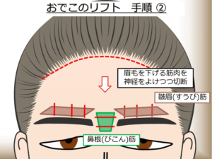 眉毛を下げる筋肉の神経をよけつつ切断