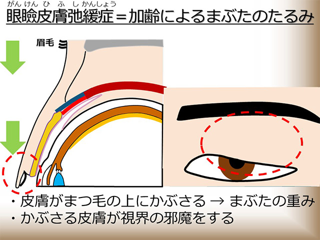 眼瞼皮膚弛緩症＝加齢によるまぶたのたるみ