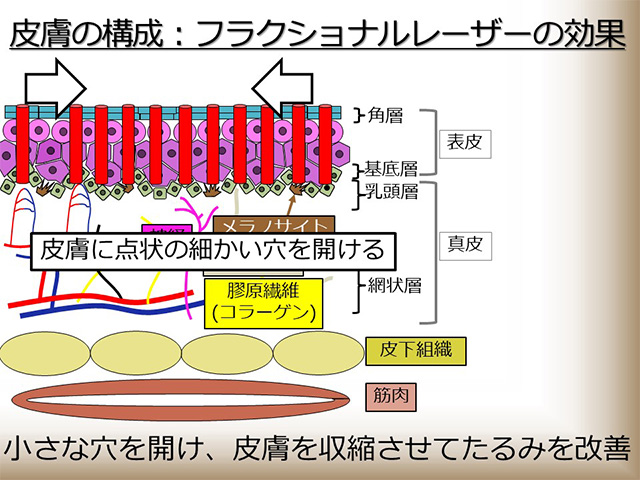 皮膚の構成：フラクショナルレーザーの効果