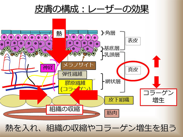 皮膚の構成：レーザーの効果