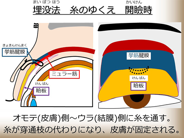 埋没法 糸の行方 開瞼時