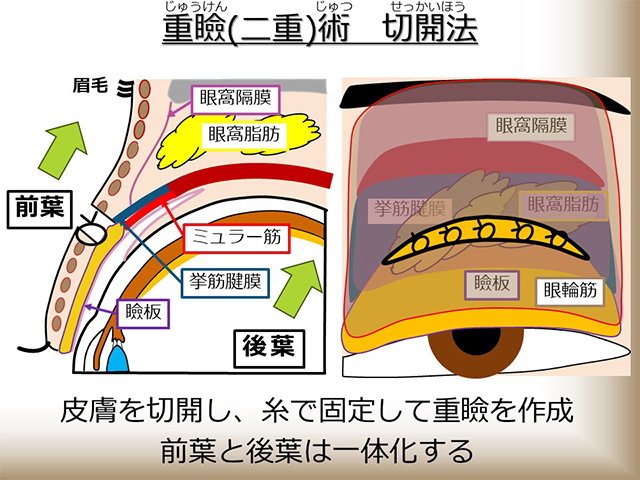 重瞼（二重）術 切開法