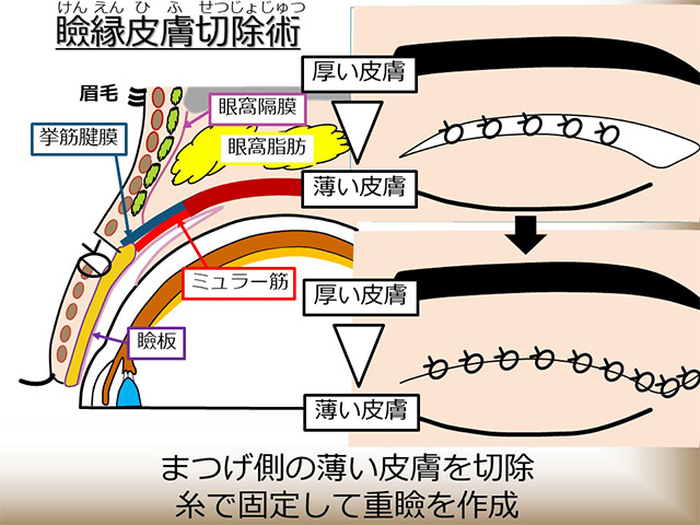 瞼縁皮膚切除術