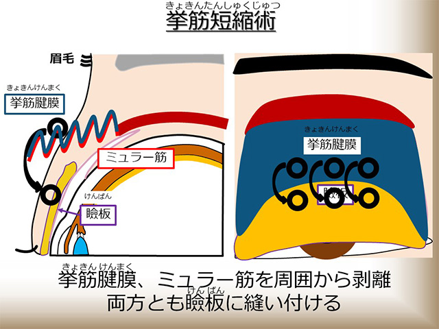 挙筋短縮術