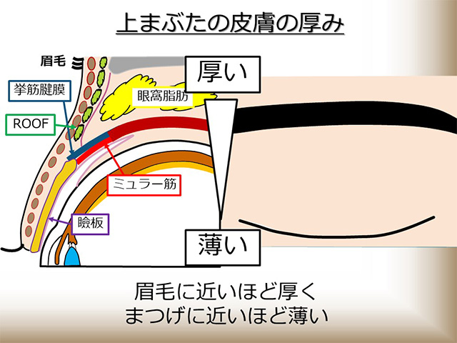 上まぶたの皮膚の厚み