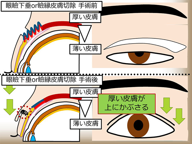 眼瞼下垂or瞼縁皮膚切除 術前術後イメージ