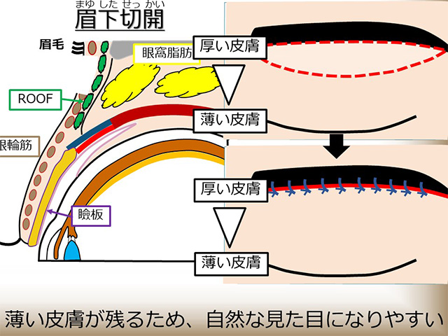 眉下切開