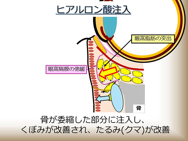 ヒアルロン酸注入