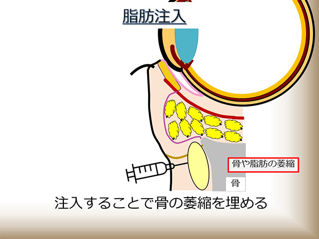 脂肪注入