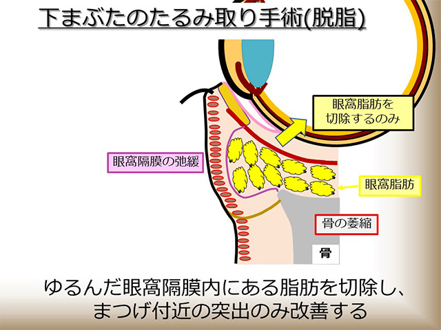 ゆるんだ眼窩隔膜内にある脂肪を切除し、まつげ付近の突出のみ改善する