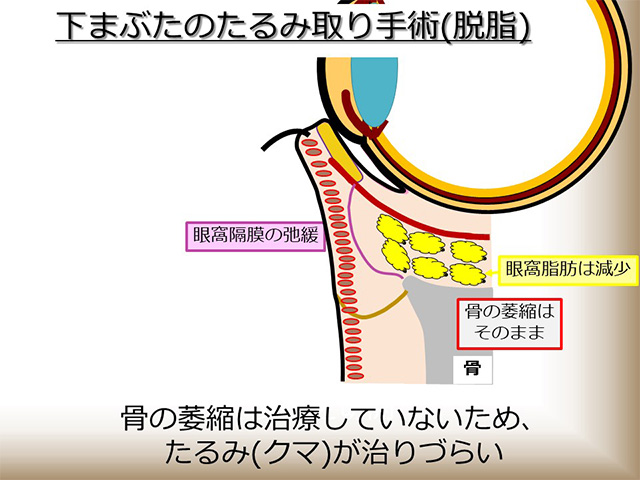 骨の萎縮は治療していないため、たるみ（クマ）が治りづらい