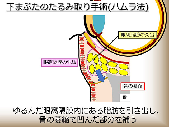 ゆるんだ眼窩隔膜内にある脂肪を引き出し、骨の萎縮で凹んだ部分を補う