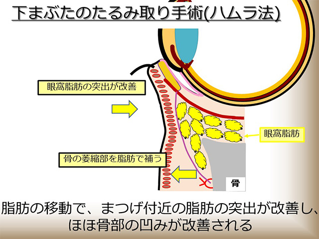 脂肪の移動で、まつげ付近の脂肪の突出が改善し、ほほ骨部の凹みが改善される