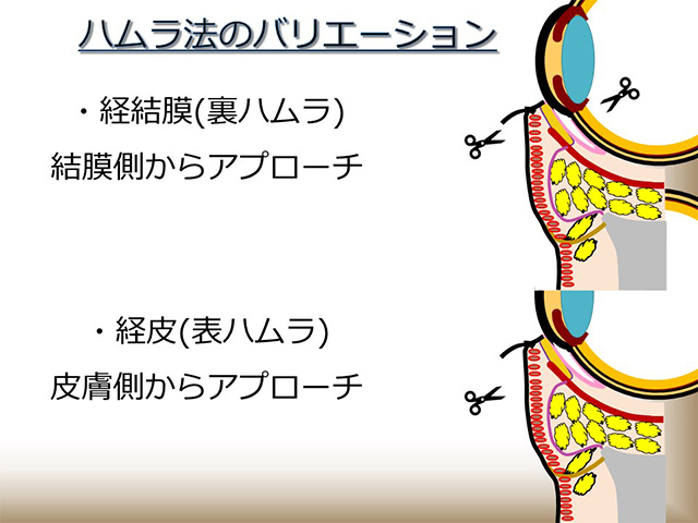 ハムラ法のバリエーション