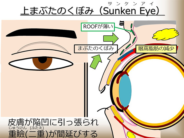 上まぶたのくぼみ（Sunken Eye）