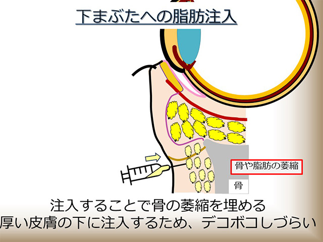 下まぶたへの脂肪注入