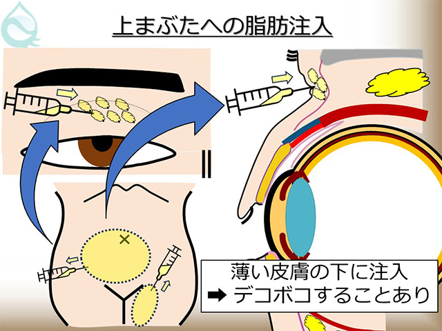 上まぶたへの脂肪注入