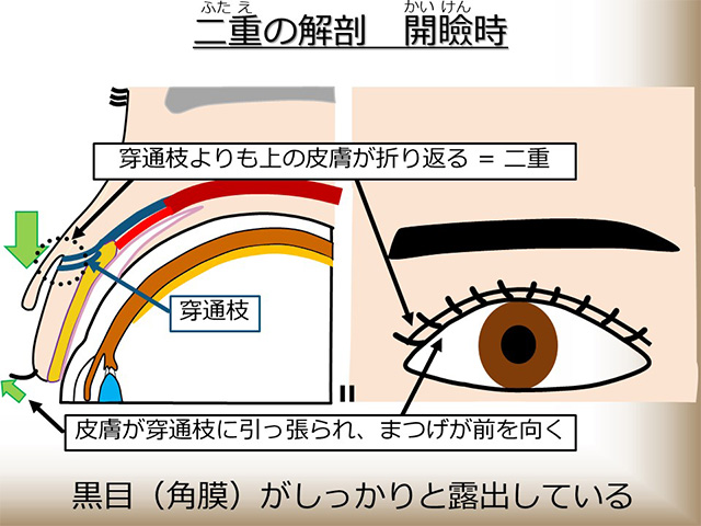 二重の解剖：開瞼時