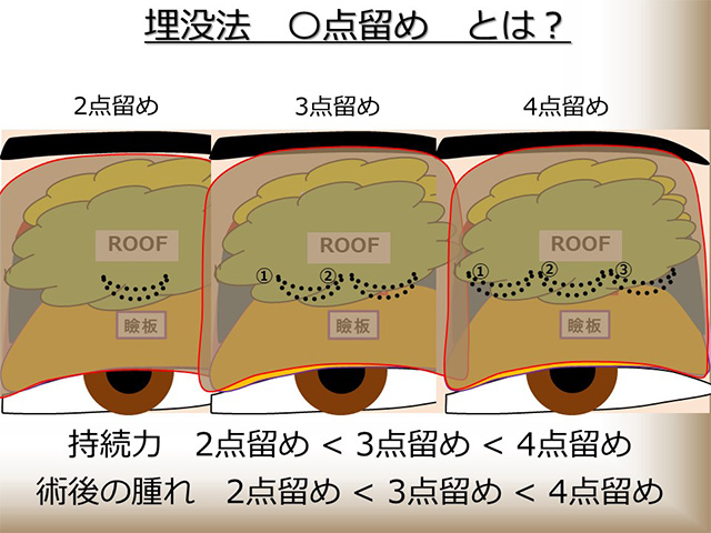 埋没法 ◯点留めとは？