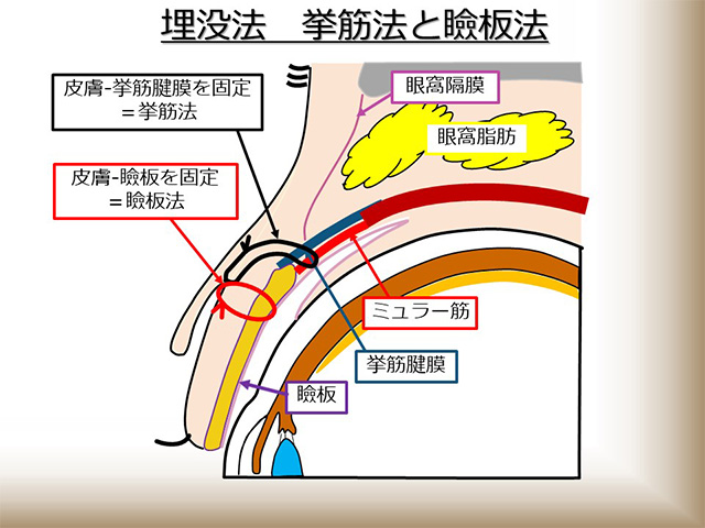 埋没法 挙筋法と瞼板法