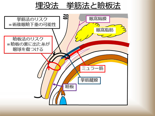 埋没法 挙筋法と瞼板法