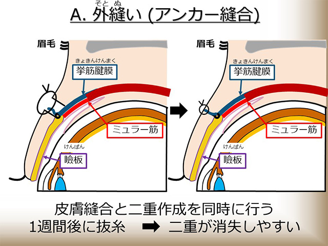 外縫い（アンカー縫合）