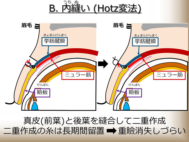 内縫い（Hotz変法）