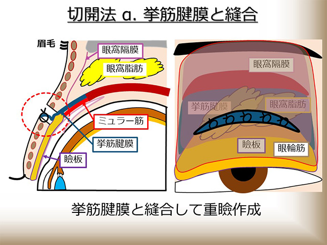 切開法 α：挙筋腱膜と縫合