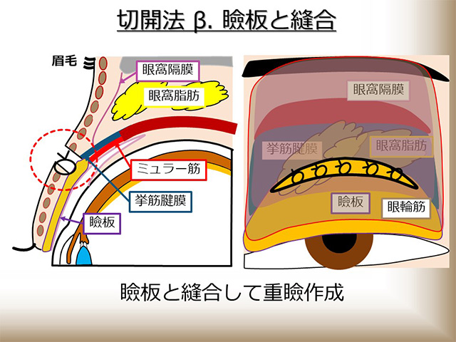 切開法 β：瞼板と縫合