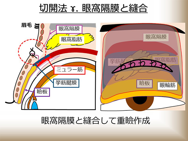 切開法 γ：眼窩隔膜と縫合