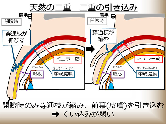 天然の二重 二重の引き込み