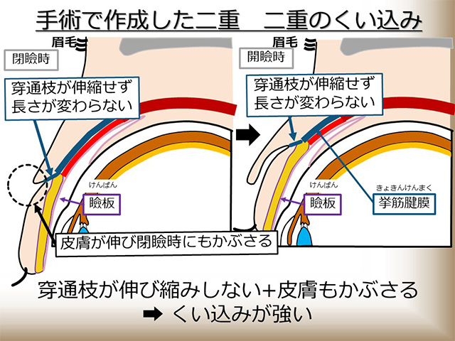 手術で作成した二重 二重のくい込み