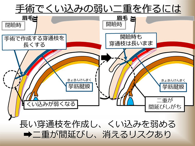 手術でくい込みの弱い二重を作るには