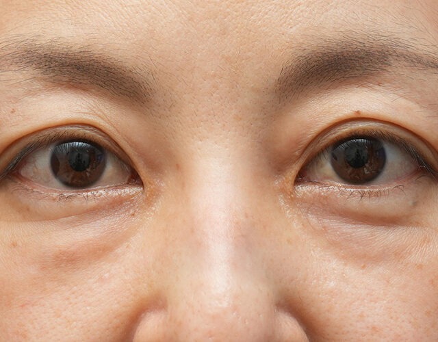 クマ取り症例_手術前