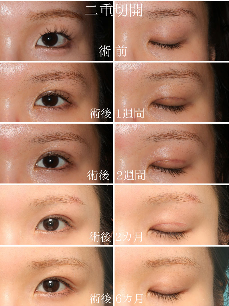 二重切開法のダウンタイム