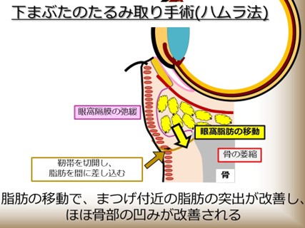 下まぶたのたるみ取り手術（ハムラ法）