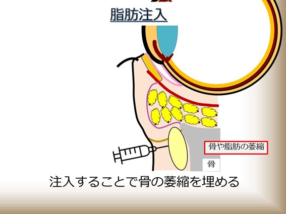 脂肪採取