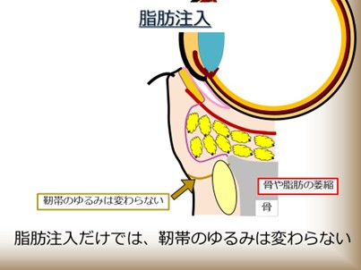 脂肪注入