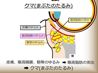 クマ（まぶたのたるみ）