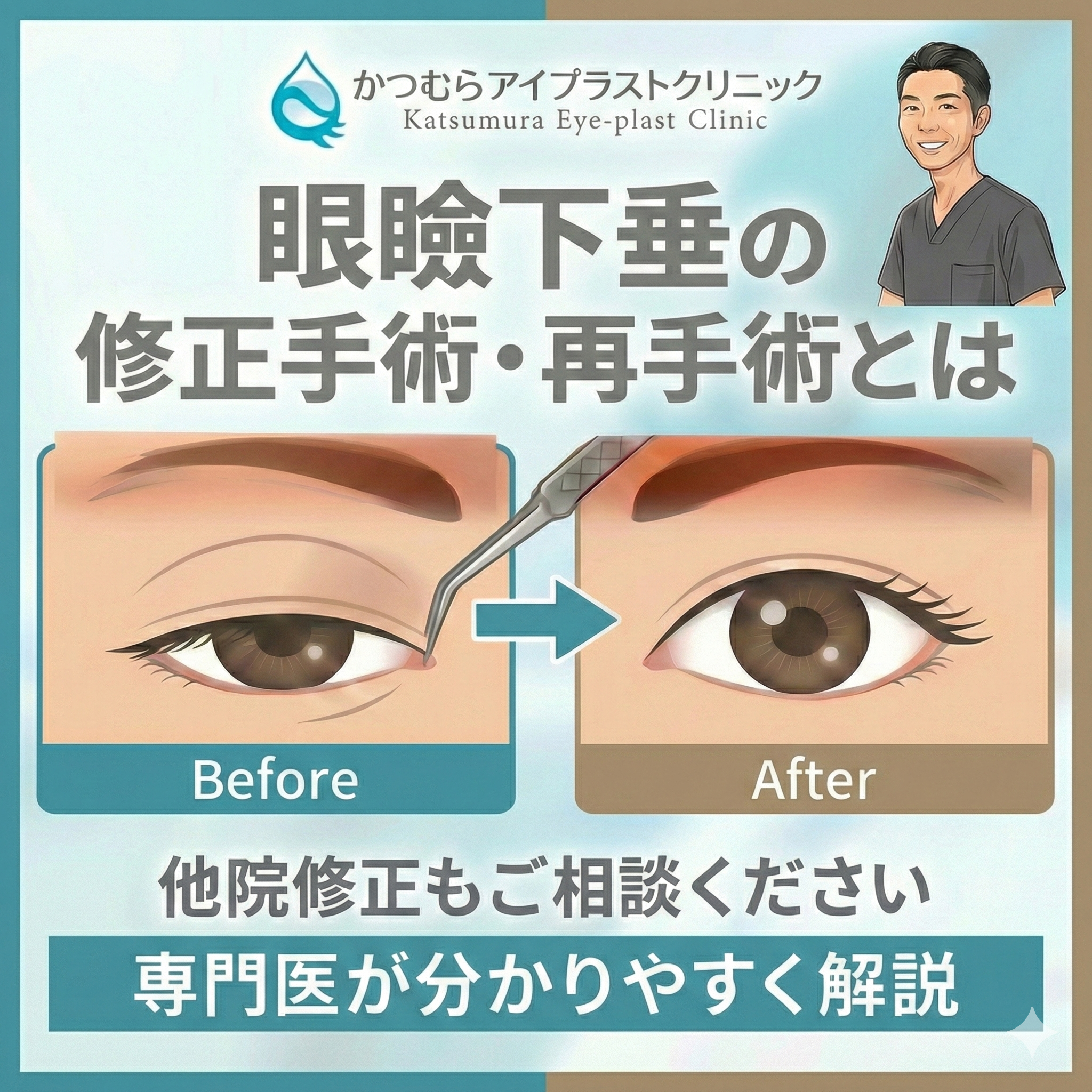 眼瞼下垂手術で失敗したと感じるケースと他院修正・再手術