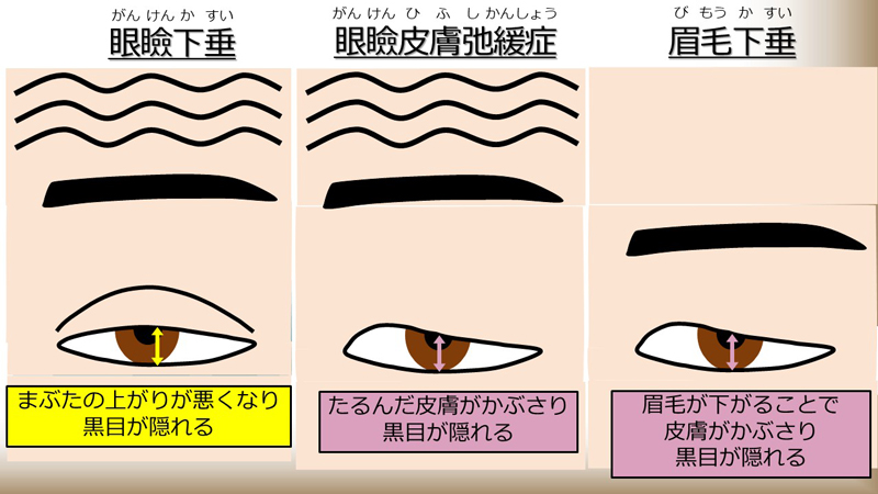 眼瞼下垂・眼瞼皮膚弛緩症・眉毛下垂