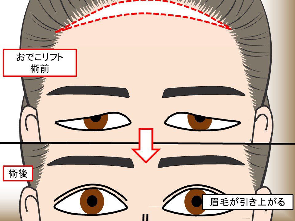 おでこリフト術前・術後
