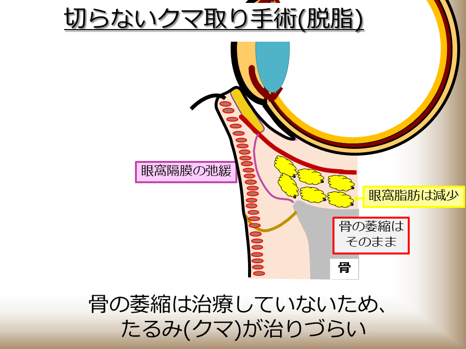 切らないクマ取り手術(脱脂)