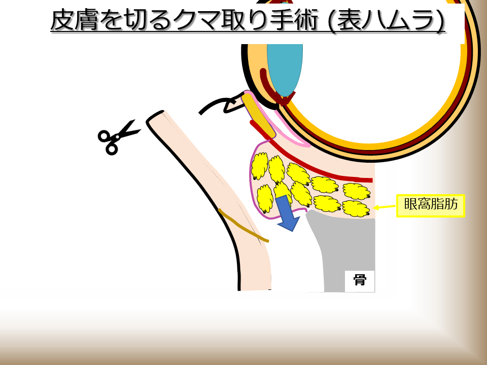 皮膚を切るクマ取り手術(表ハムラ)