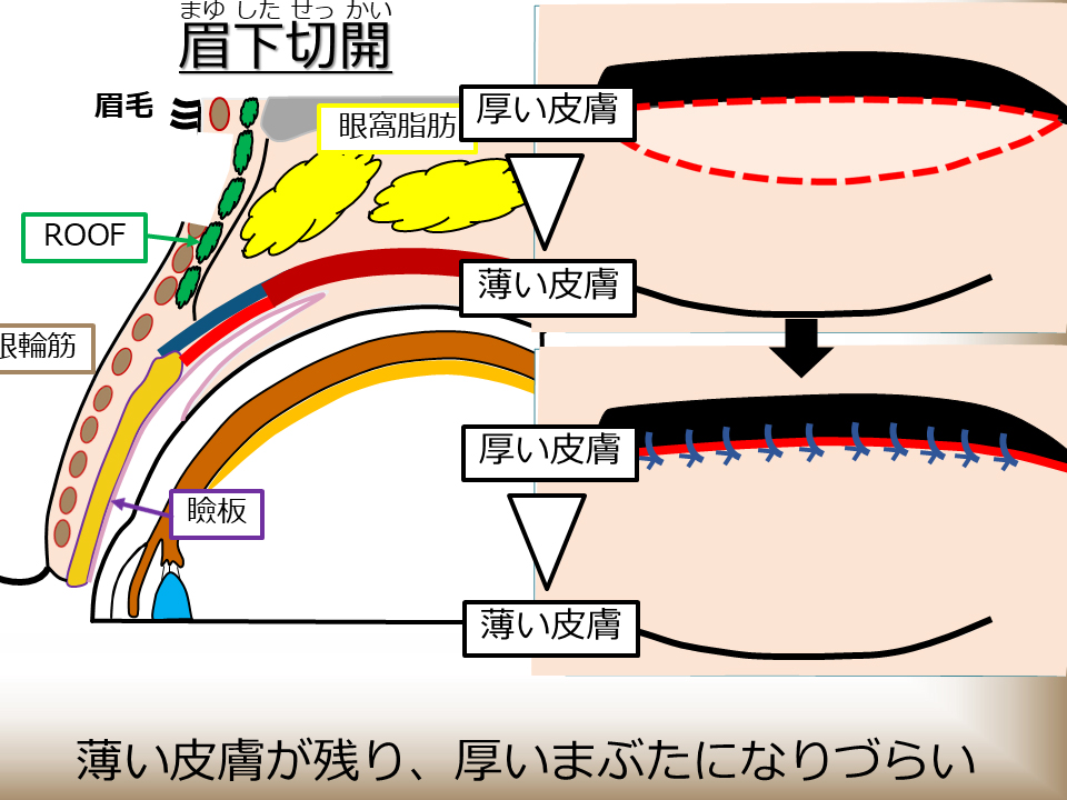 眉下切開 薄い皮膚が残り、厚いまぶたになりづらい
